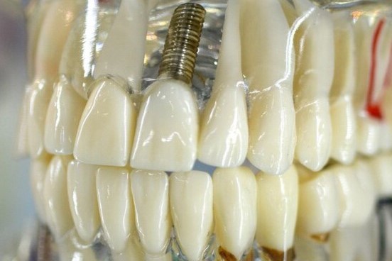 Related Implant Solutions & Advanced Care