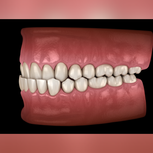 Underbite