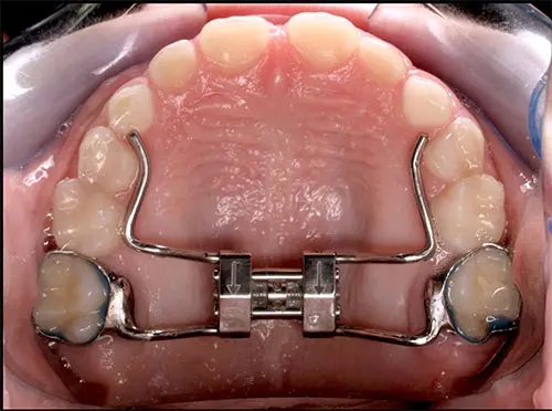 Palatal Expanders