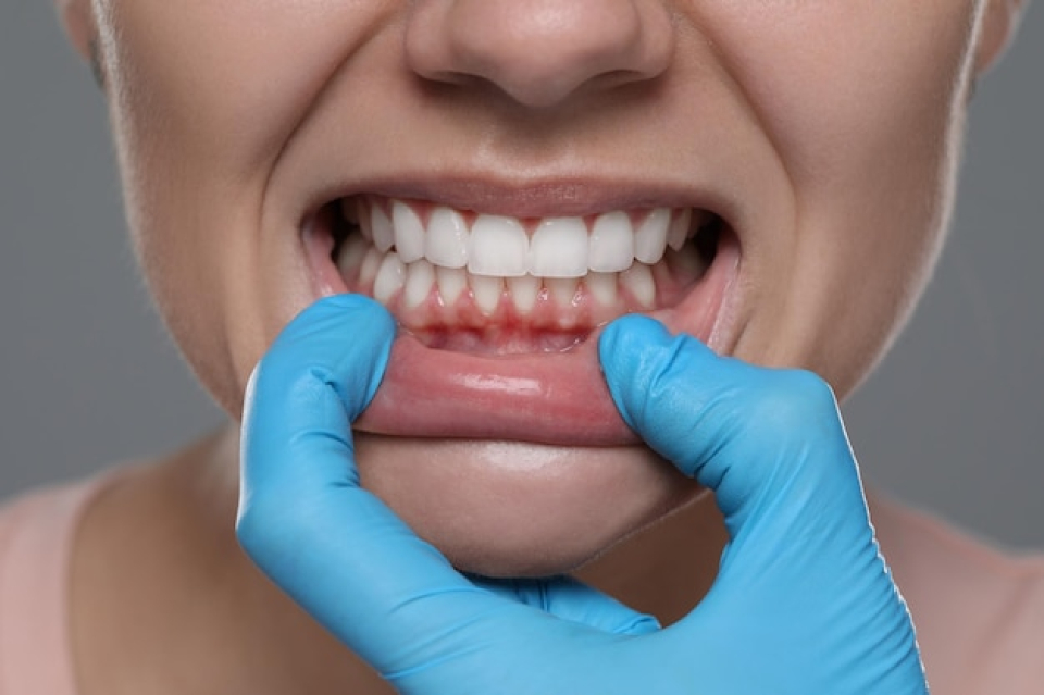 Periodontal Disease Treatment