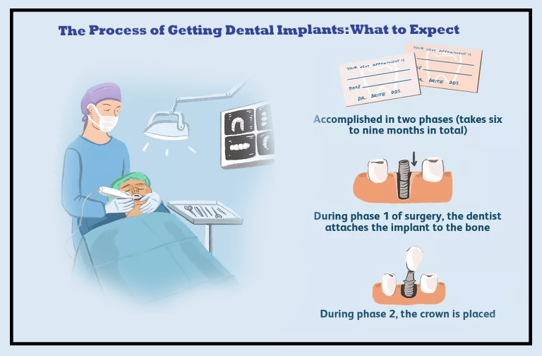 The Process of Getting Dental Implants: What to Expect